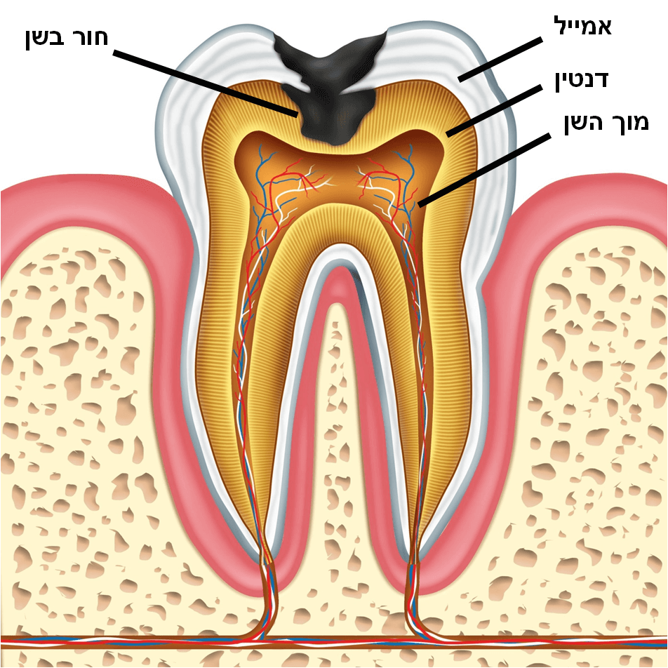 חור בשן